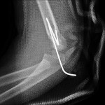 Fig. 1-D Postoperative radiograph after closed reduction and percutaneous pinning of the supracondylar fracture of the distal part of the humerus: lateral view.
