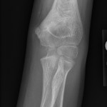 Fig. 2-A Anteroposterior radiograph demonstrating the healed fracture four years after closed reduction and percutaneous pinning of the supracondylar fracture of the distal part of the humerus.
