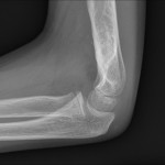 Fig. 2-B Lateral radiograph demonstrating the healed fracture four years after closed reduction and percutaneous pinning of the supracondylar fracture of the distal part of the humerus.
