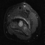 Fig. 4-B Axial magnetic resonance image demonstrating lucencies in the distal part of the humerus.
