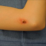 Fig. 5 Draining wound overlying the distal part of the upper arm medially.
