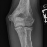 Fig. 6-A Anteroposterior radiograph one year after surgical irrigation and debridement.
