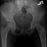 Fig. 1-A Anteroposterior radiograph of the pelvis shows a radiolucent lesion with a stippled mineralization pattern occupying the neck and metaphysis of the left femur; no periosteal reaction is evident.
