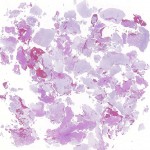 Fig. 2-A Hematoxylin and eosin stain. Whole-section histological image demonstrating mixed gross appearance of woven bone, fibrous tissue, and massive chondroid components (10× magnification).
