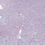Fig. 2-B Hematoxylin and eosin stain. Low-power histological image demonstrating bland, hypercellular stroma with intermixed islands of cartilage and woven bone (50× magnification).
