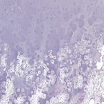 Fig. 2-D Hematoxylin and eosin stain. Low-power histological image showing cartilaginous stroma reminiscent of epiphyseal cartilage (50× magnification).
