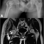 Fig. 1 Imaging at presentation. Fig. 1-A The radiograph revealed a pathologic trochanteric fracture through an osteolytic lesion with a thin sclerotic rim. Fig. 1-B T2-weighted MRI of the right hip revealed an 8.9 cm (craniocaudal) × 7.0 cm (transverse) × 6.0-cm (anteroposterior) trabeculated cystic mass with combined hemorrhage, fluid level, and peripheral and septal enhancement with a solid-looking enhancing portion.
