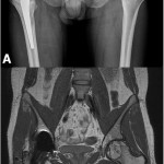 Fig. 3 Imaging at forty-three months postoperatively. Fig. 3-A The radiograph showed a large lytic lesion with a thin sclerotic rim located on the uppermost subchondral bone on the left femoral head. There was no cortical break, periosteal reaction, or matrix calcification.  Fig. 3-B  T1-weighted MRI showed a heterogeneous hyperintense lesion with a thin rim of low-signal intensity and internal septa on the left femoral head. The lesion averaged 4.5 cm (craniocaudal) × 3.6 cm (transverse) × 3.1 cm (anteroposterior) in diameter.
