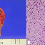 Fig. 4 Pathology. Fig. 4-A Gross appearance of the left-sided lesion showing multiloculated hemorrhagic cysts with a thin sclerotic rim. No periosteal reaction or extraskeletal extension was found. Fig. 4-B High-power histology demonstrating sheets of cells with chondroid intercellular matrix and giant cells (×400).
