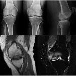Fig. 1 Initial radiographs (top row) and MRI (bottom row) of the left knee with the lesion involving the medial femoral condyle and the accompanying medial meniscal tear. The MRI demonstrates the low T1-weighted, high T2-weighted signal intensity of the lesion with accompanying marrow edema.
