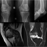 Fig. 2 Follow-up radiographs (top row) and MRI (bottom row) demonstrate the increased size of the lesion.
