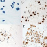 Fig. 4 Pathology slides (63× magnification) from fine needle aspirations showing tumor cells (hematoxylin and eosin stain) (Fig. 4-A), estrogen-receptor positive staining (Fig. 4-B), progesterone-receptor positive staining (Fig. 4-C), and equivocal HER2 protein staining, later shown to be positive on FISH analysis (Fig. 4-D).
