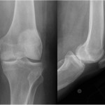 Fig. 5 Anteroposterior (left) and lateral (right) radiographs showing postradiation articular surface collapse with a stable-sized lesion.
