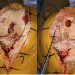 Fig. 6 Intraoperative photographs showing the subchondral collapse (left) of the medial femoral condyle and limited osseous loss (right), which did not require augmentation.

