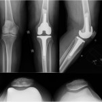 Fig. 7 Radiographs obtained two years following total knee arthroplasty, with no evidence of loosening, wear, or recurrence.
