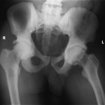 Fig. 1-A Anteroposterior radiograph of the pelvis demonstrating heterotopic ossification and dense sclerosis of both hips. 
