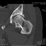 Fig. 1-B Coronal CT image of the left hip showing generalized osteosclerosis with trabecular condensation and areas of trabecular rarefaction.
