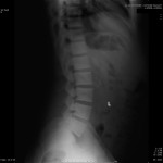 Fig. 2 Lateral lumbar spine radiograph demonstrating diffuse osteosclerosis with a chalky white appearance.
