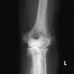 Fig. 3-A Anteroposterior radiograph of the left elbow demonstrating heterotopic ossification, sclerosis, and synostosis. 
