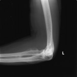 Fig. 3-B Lateral radiograph of the left elbow demonstrating heterotopic ossification, sclerosis, and synostosis.
