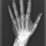 Fig. 4-A Anteroposterior radiograph of the left hand demonstrating striking periostitis deformans (cloaking undulating periostitis).
