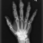 Fig. 4-B Anteroposterior radiograph of the right hand demonstrating striking periostitis deformans (cloaking undulating periostitis).
