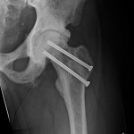 Fig. 6-B Interval anteroposterior radiograph of the left hip showing healing and some resolution of the dense sclerosis at six months postoperatively.
