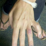 Fig. 1-A Photograph showing the chronic dorsal cutaneous lesion of the ring finger with erythematous nodules.
