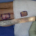 Fig. 1-B Photograph showing the wide excision of the chronic dorsal cutaneous lesion of the ring finger.
