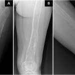 Fig. 1 Radiographs of the femur at initial presentation, including an anteroposterior view of the hip (Fig. 1-A), an anteroposterior view of the femur (Fig. 1-B), and a lateral view of the femur (Fig. 1-C).
