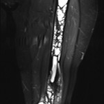 Fig. 2 Coronal slice of a T2-weighted MRI scan of the femur illustrates diffuse involvement of the entire femur.
