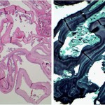 Fig. 3 Low-magnification photomicrograph of the needle biopsy specimen with hematoxylin and eosin stain (left) and GMS stain (right).
