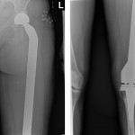 Fig. 5 Anteroposterior radiographs of the left hip (left) and the left knee (right) at the one-year follow-up.
