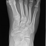 Fig. 1-A Anteroposterior radiograph of the right foot at the time of presentation. Note the well-corticated osseous fragment medial to the head of the first metatarsal.
