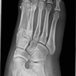 Fig. 1-B Oblique radiograph of the right foot at the time of presentation. Note the well-corticated osseous fragment medial to the head of the first metatarsal.
