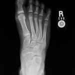 Fig. 2-A Anteroposterior radiograph of the right foot obtained approximately one year prior for unrelated symptoms. Again, note the osseous fragment medial to the head of the first metatarsal, which is less well-corticated than in the more recent radiographs (Figs. 1-A and 1-B).
