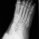 Fig. 2-B Oblique radiograph of the right foot obtained approximately one year prior for unrelated symptoms. Again, note the osseous fragment medial to the head of the first metatarsal, which is less well-corticated than in the more recent radiographs (Figs. 1-A and 1-B).
