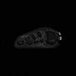 Fig. 3-A Representative MRI of the right foot. Coronal proton density fat-suppressed image through the fragment.
