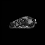 Fig. 3-B Representative MRI of the right foot. Coronal T1-weighted image through the fragment and sesamoids. Note the increased fluid signal in the sesamoids.

