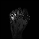 Fig. 3-C Representative MRI of the right foot. Axial proton density fat-suppressed image at the level of the fragment.
