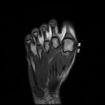 Fig. 3-D Representative MRI of the right foot. Axial T1-weighted image through the fragment.
