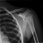 Fig. 1 Radiograph presenting an anteroposterior view of the left shoulder.
