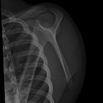 Fig. 2 Radiograph presenting a scapular-Y view of the left shoulder.
