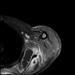 Fig. 3 Axial T2-weighted MRI with intravenous contrast.
