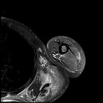 Fig. 4 Axial T2-weighted MRI with intravenous contrast.

