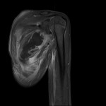 Fig. 6 Coronal T2-weighted MRI with intravenous contrast.
