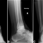 Fig. 1 Preoperative anteroposterior (Fig. 1-A), lateral (Fig. 1-B), and mortise (Fig. 1-C) radiographs of the ankle.
