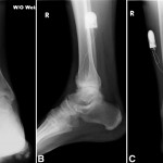 Fig. 4 Anteroposterior (Fig. 4-A), lateral (Fig. 4-B), and mortise (Fig. 4-C) radiographs of the ankle demonstrating the implanted bone stimulator at five months postoperatively.
