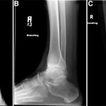 Fig. 5 Anteroposterior (Fig. 5-A), lateral (Fig. 5-B), and mortise (Fig. 5-C) radiographs of the ankle demonstrating maintenance of the talar dome without any evidence of ankle arthritis at fourteen months postoperatively.
