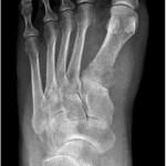 Fig. 2 Radiograph of the left foot ten days after initial presentation
